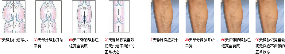脈活靜脈曲張修復液