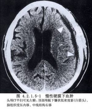 慢性硬膜下出血清除術