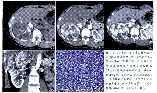 後腎腺瘤CT表現
